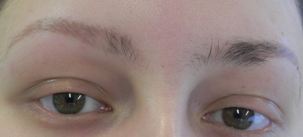 Alopecia areata wenkbrauw uitval